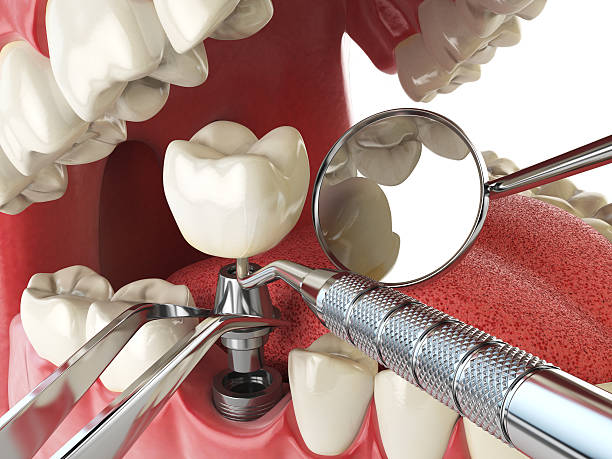 Best Emergency Root Canal Treatment in Salmon Creek, WA