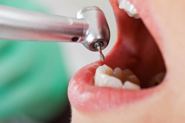 Best Emergency Tooth Extraction in Salmon Creek, WA